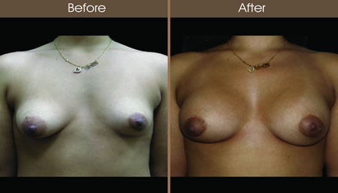 Breast Asymmetry Before And After Front View