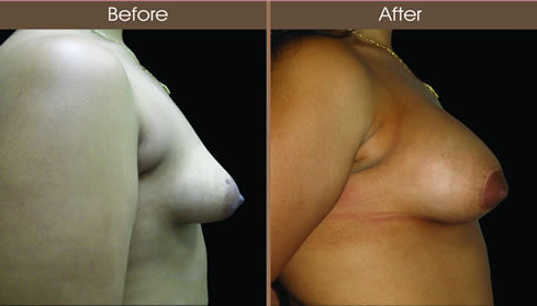 Breast Asymmetry Before And After Right Side View