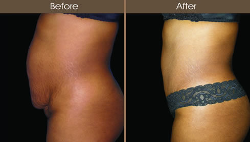 Tummy Tuck Surgery Results
