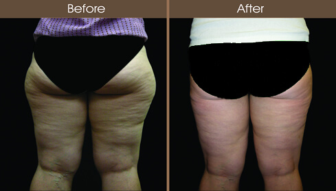 Liposuction Before And After Back Image