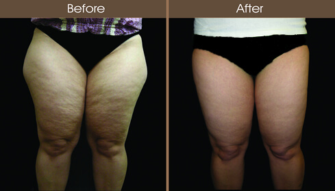 Liposuction Before And After Front Image