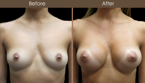 Breast Augmentation Surgery Before And After Front View