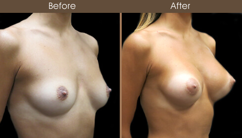 Breast Augmentation Surgery Before And After Right Quarter View