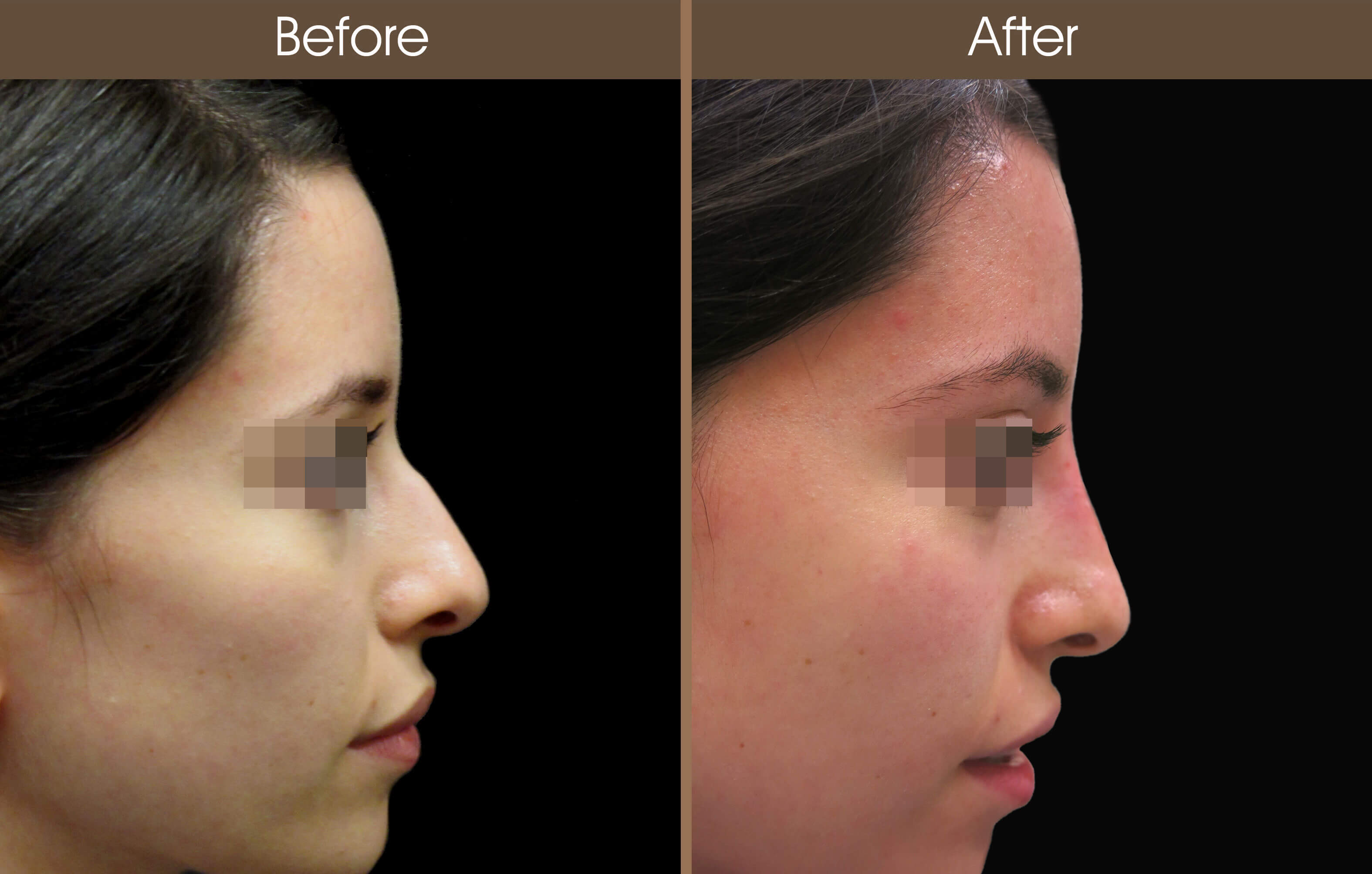 Non-Surgical Rhinoplasty Before And After