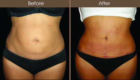 Tummy Tuck Surgery Before And After Front View