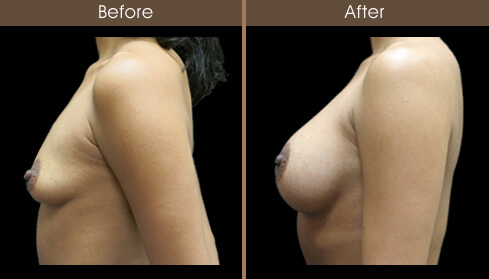 Before And After Breast Implants