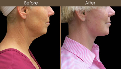 Neck Lift Before And After Right Side View