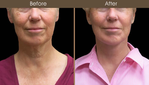 Facelift Before And After Front Image