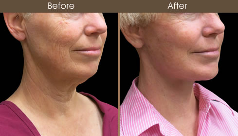 Facelift Before And After Right Quarter Image