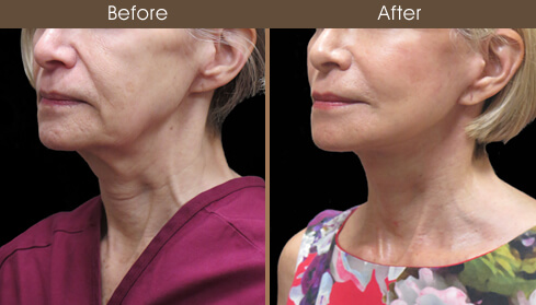 Facelift Surgery Before And After Left Quarter View