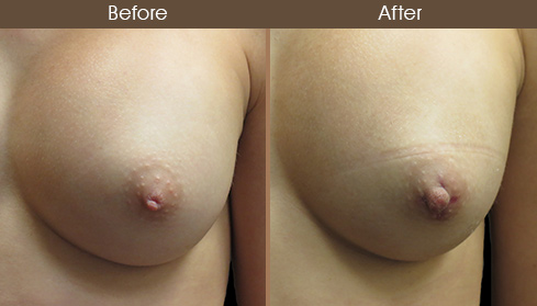 Inverted Nipple Surgery Results