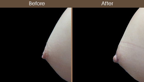 Before & After Inverted Nipple Surgery