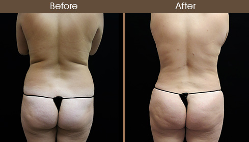 Liposuction Surgery Before & After Back Image