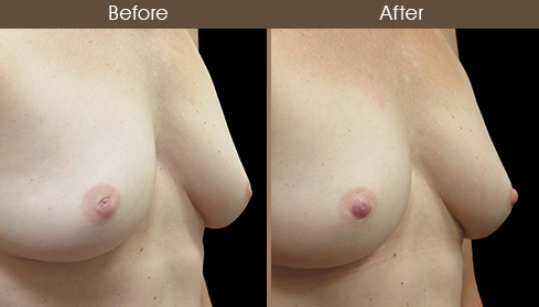 Nipple Correction Before & After