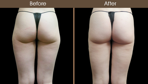 Thigh Liposuction Before And After