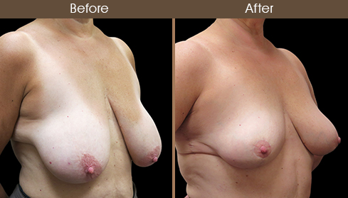 Before And After Breast Reduction Right Quarter Image