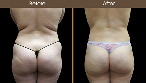Before And After Liposuction Back Image