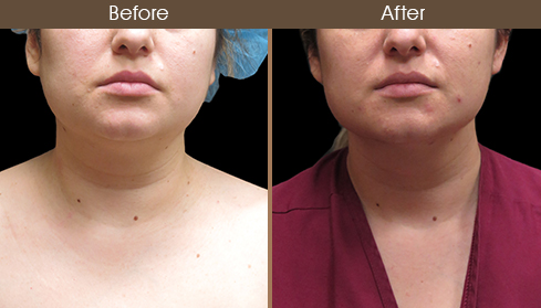 Before And After Neck Liposuction Front View