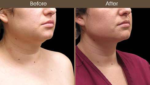 Before And After Neck Liposuction Right Quarter View