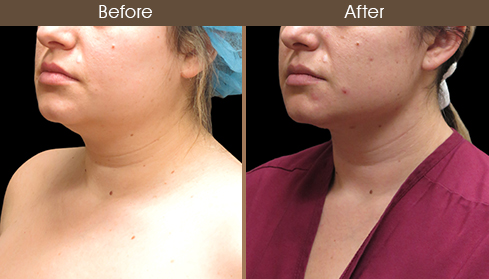 Before And After Neck Liposuction Left Quarter View
