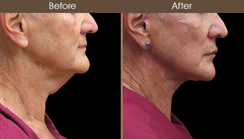 Before And After Neck Lift Right Side View