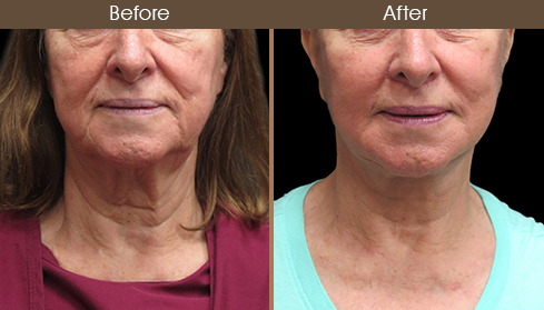 Before And After Neck Lift Front Image
