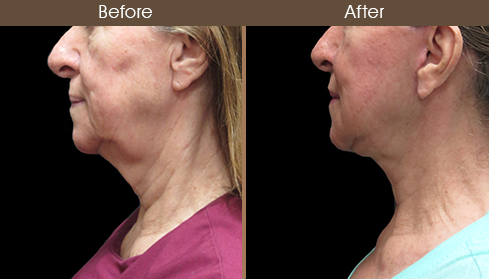 Before And After Facelift Left Side Image