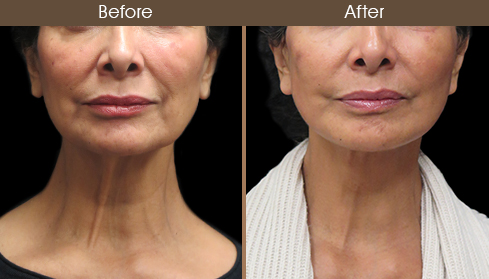 Before And After Facelift Surgery Front Image