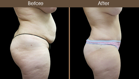 Before And After Tummy Tuck Right Side Image