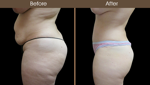 Before And After Tummy Tuck Left Side Image