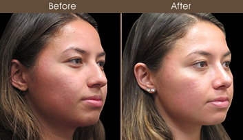 Before & After Rhinoplasty In New York