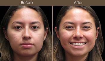 Before And After Rhinoplasty In New York City