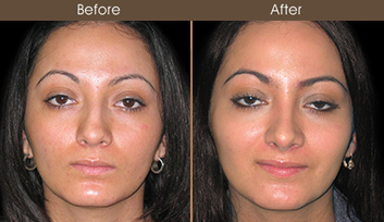 Nose Reshaping Before And After