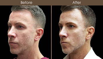 Before And After Rhinoplasty Surgery