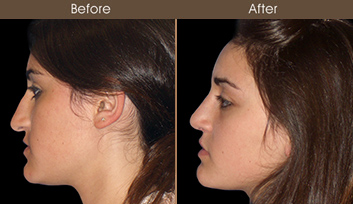Before & After Rhinoplasty Treatment