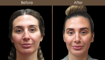 Before And After Nose Reshaping Surgery In NYC