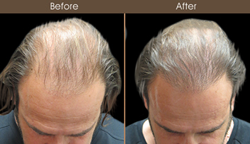 Hair Restoration In NYC Before & After