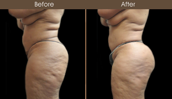 NYC Liposuction Before And After
