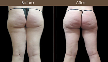 Before & After NYC Liposuction