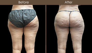New York Liposuction Surgery Before And After