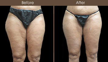 New York Liposuction Surgery Before & After