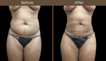 New York City Liposuction Surgery Before & After