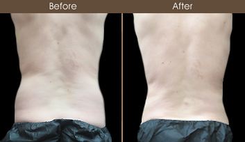 Male Liposuction Results