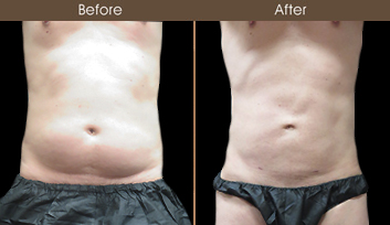Male Lipo Before And After