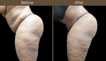 New York City Abdominoplasty Before And After