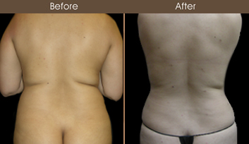 Before And After New York Liposuction