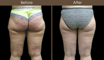 Before & After Thigh Lift