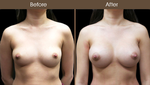 Breast Implant Before And After