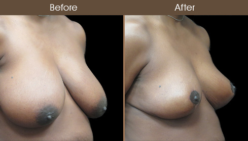 Before & After Breast Reduction