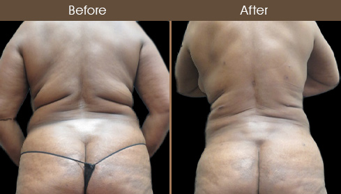 Lipo Surgery Before And After